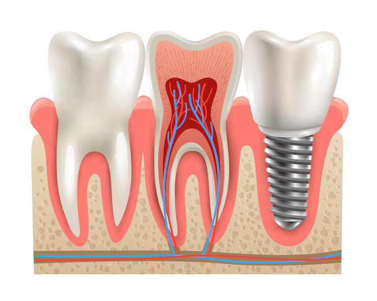 Dental Implant in Greater Noida West