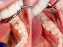 Teeth fillings In Greater Noida West