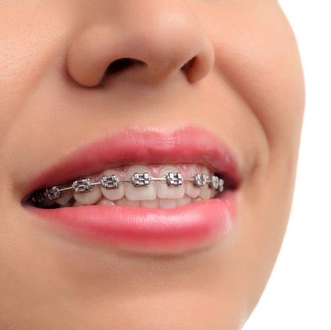 Dental Braces In Greater Noida West