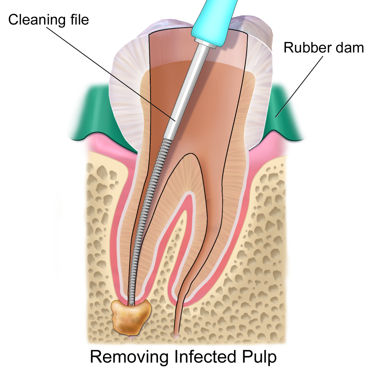 Root Canal Treatment in Greater Noida West