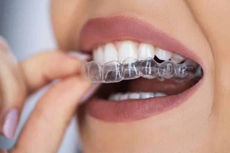 Best Clear Aligners In Greater Noida West