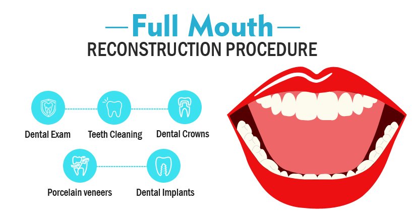 Full Mouth Rehabilitation in Greater Noida West