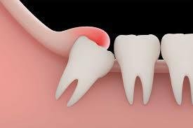 Wisdom Tooth Removal in Greater Noida West