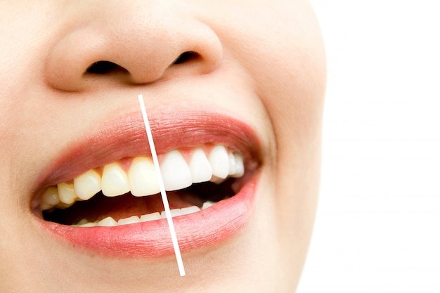 Best Teeth Whitening Treatment in Noida