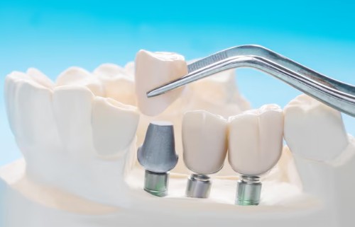 Best Teeth Bridge Centre in Greater Noida West