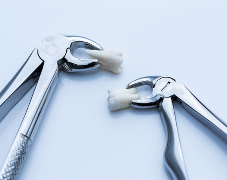 Best Wisdom Teeth Extraction in Greater Noida