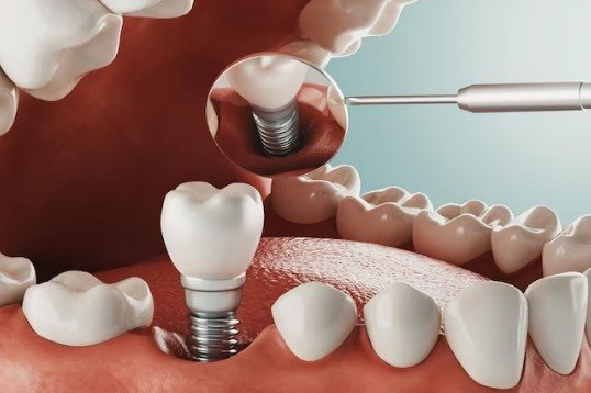 Best Dental Implant Services in Greater Noida