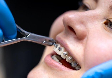 Best Teeth Braces Services in Greater Noida West
