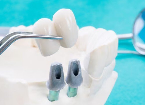 Best Dental Bridge Centre in Greater Noida