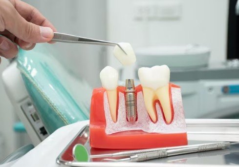 Best Dental Implant Services in Greater Noida