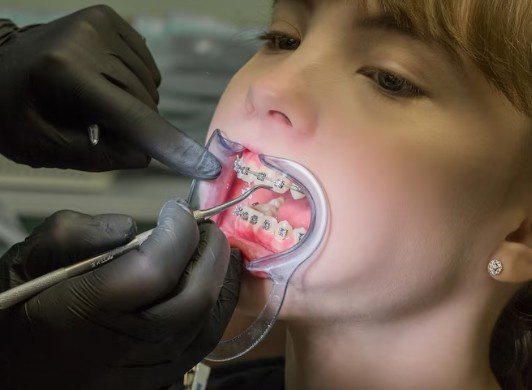 Best Dental Braces Centre in Greater Noida West