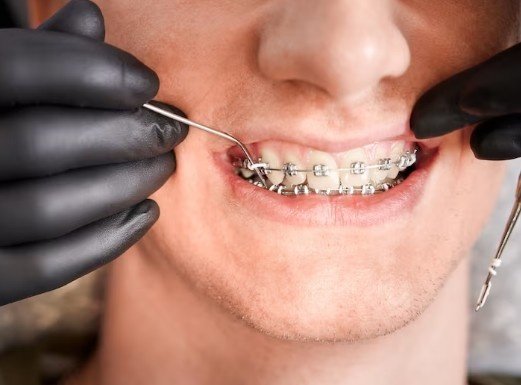 Best Teeth Braces Doctor in Greater Noida
