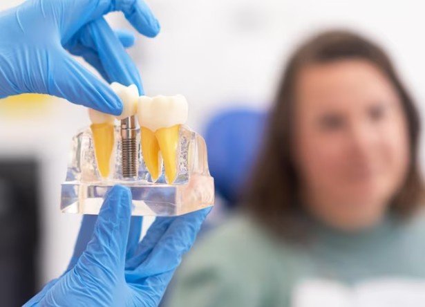 Best Dental Implant Clinic in Greater Noida