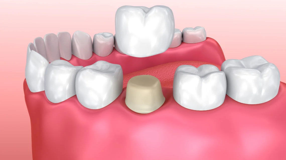 Dental Crowns Procedure in Greater Noida West
