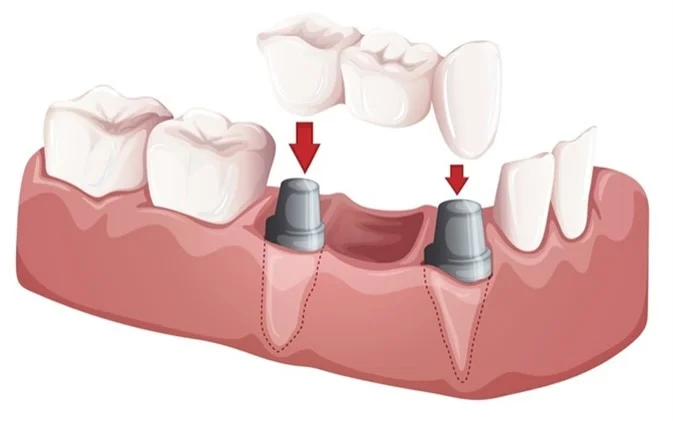 Best Doctor for Dental Bridges in Greater Noida West
