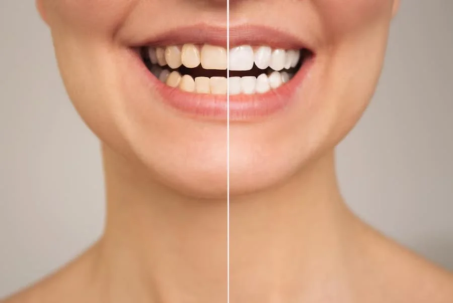 Best Teeth Whitening Treatment in Greater Noida