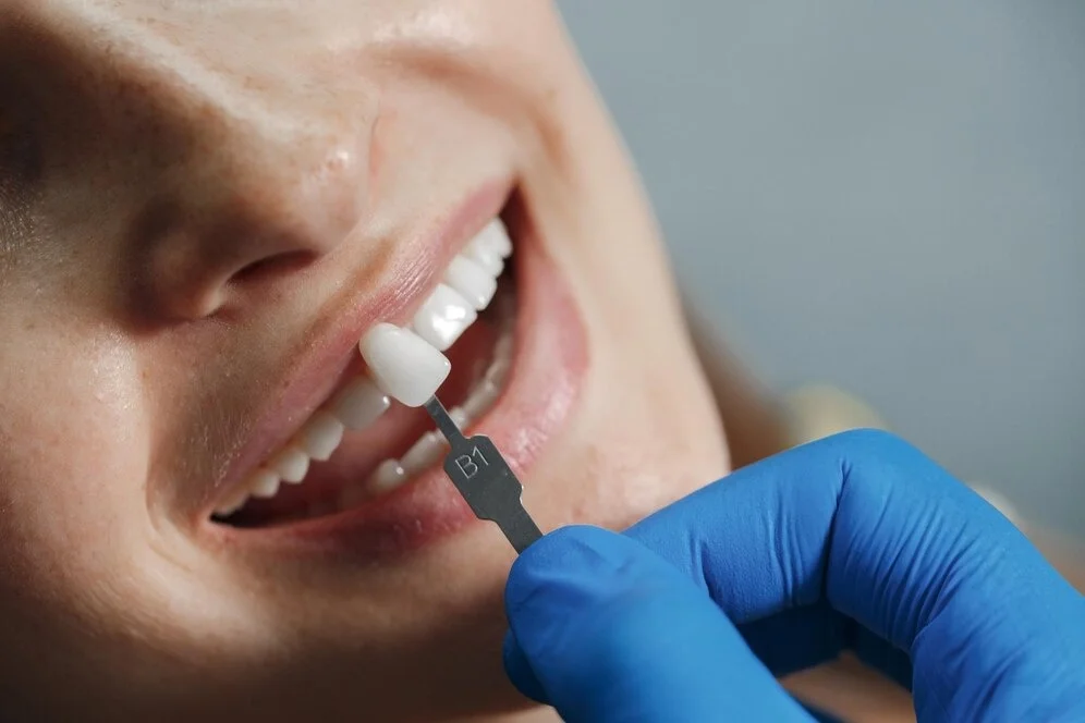 Dental Crowns Services in Greater Noida