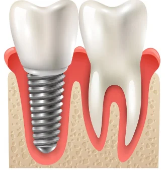 Best Dental Crowns in Greater Noida
