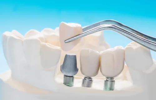 Best Teeth Bridge Centre in Greater Noida West
