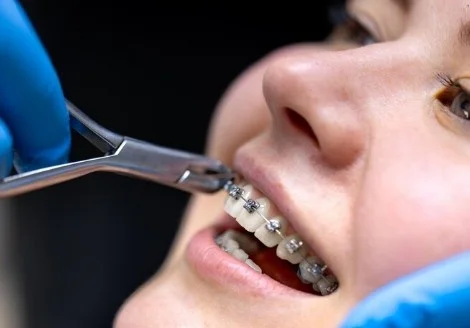 Best Teeth Braces Services in Greater Noida West