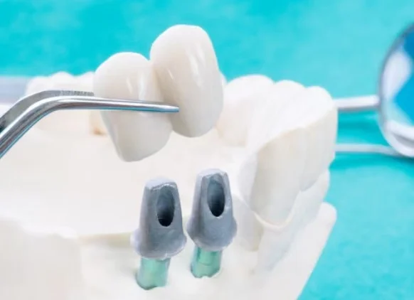 Best Dental Bridge Centre in Greater Noida