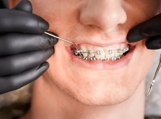 Best Teeth Braces Doctor in Greater Noida