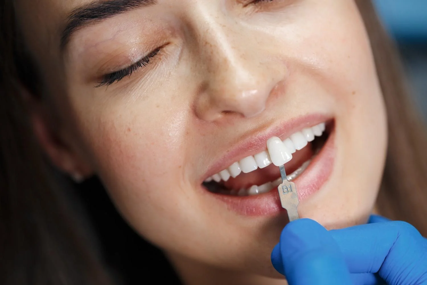 Best Porcelain Veneers in Greater Noida
