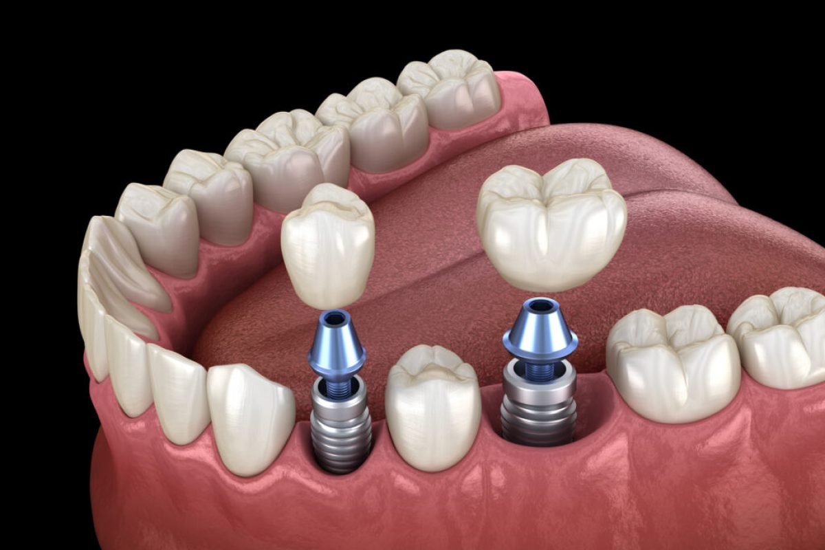 Premolar and Molar tooth crown installation over implant, screw fixation. 3D illustration of dental treatment